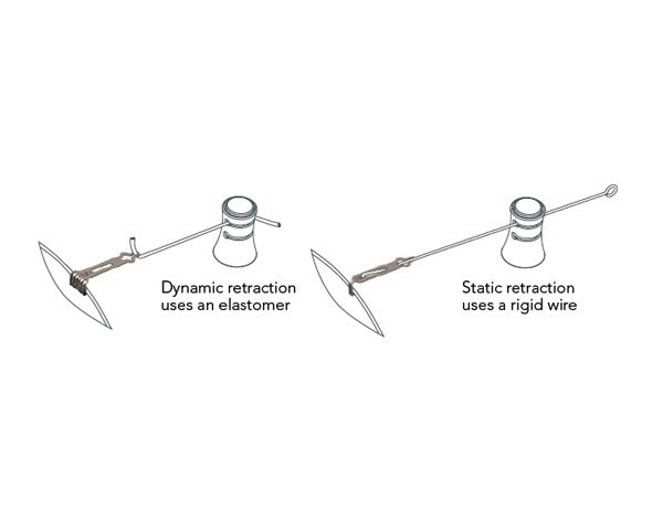 Static & Dynamic Retraction