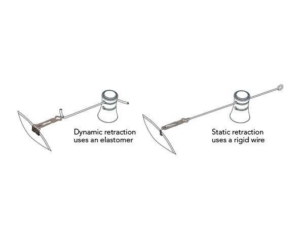 Static & Dynamic Retraction